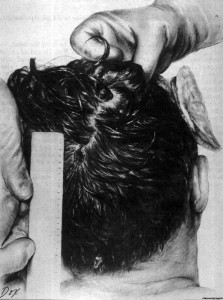 Drawn replication of a photograph depicting the posterior head wound of President Kennedy. (Image: Courtesy of Wikipedia)